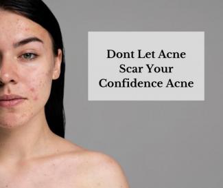 Η συμβολή της Προηγμένης Ομοιοπαθητικής στην αντιμετώπιση της ακμής