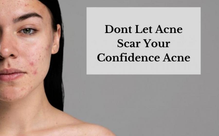 Η συμβολή της Προηγμένης Ομοιοπαθητικής στην αντιμετώπιση της ακμής