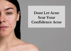 Η συμβολή της Προηγμένης Ομοιοπαθητικής στην αντιμετώπιση της ακμής